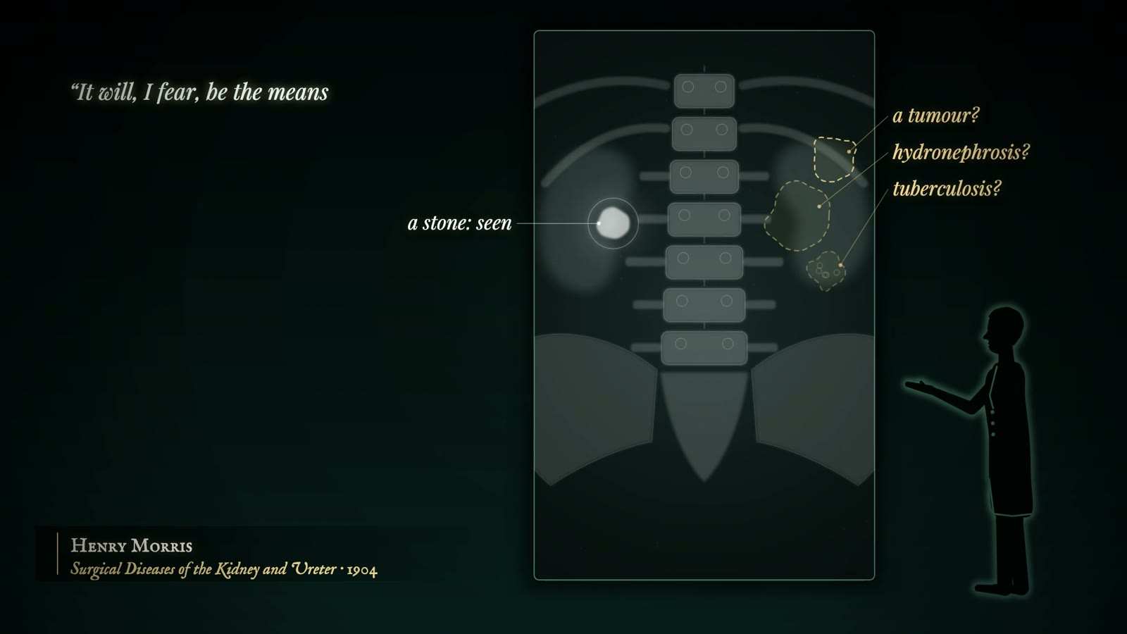 X-ray style view of the spine with a bright stone labelled a stone: seen, and dashed outlines labelled a tumour?, hydronephrosis? and tuberculosis?