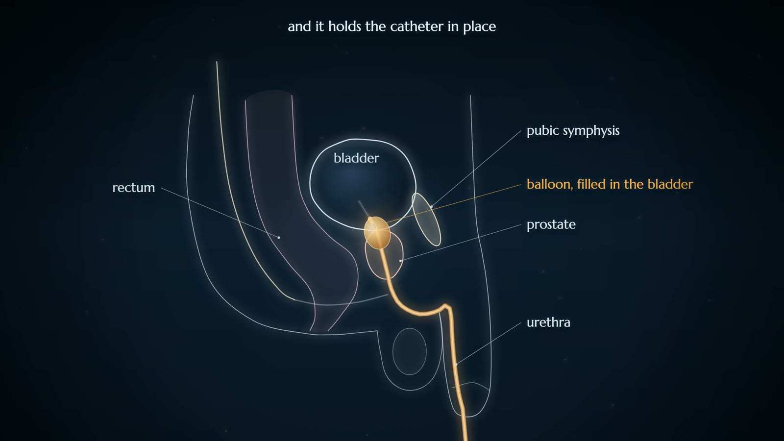 Side-view diagram of the male pelvis with a catheter running up the urethra and a filled balloon in the bladder, labelled rectum, prostate and pubic symphysis.