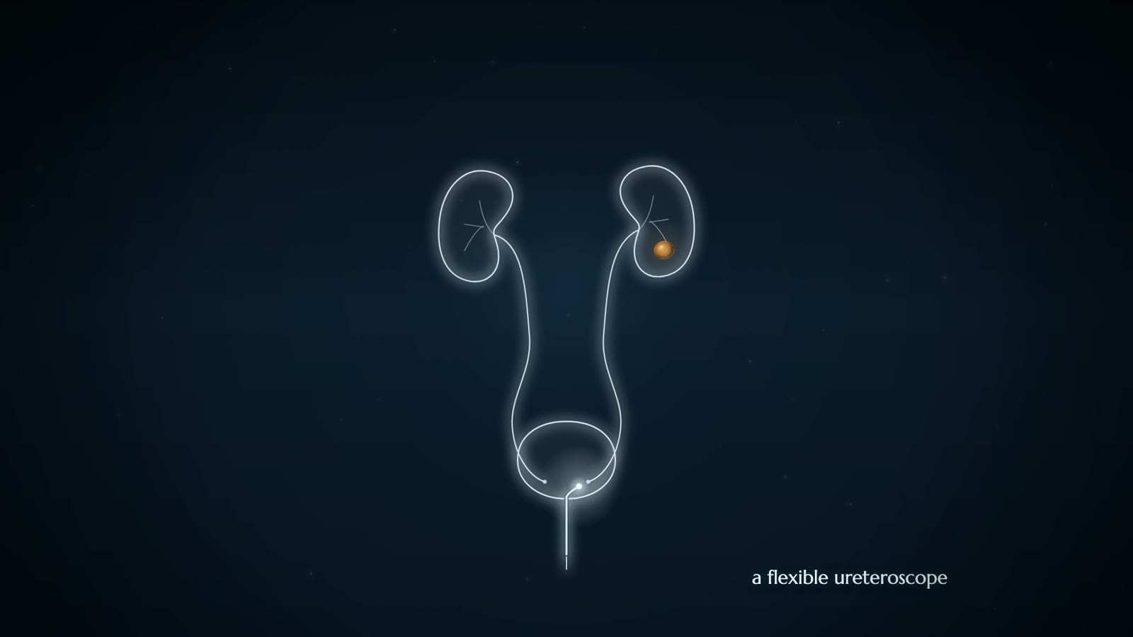 Outline of two kidneys, ureters and bladder, an amber stone in one kidney and a thin scope entering the bladder from below, captioned a flexible ureteroscope.