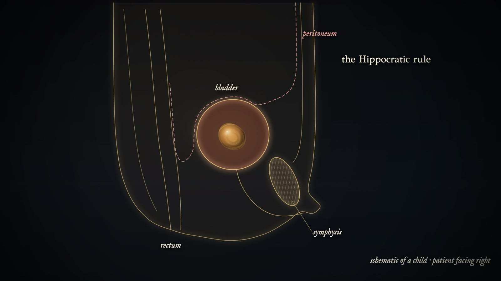 Gold-line side view of a child's pelvis with an amber stone in the bladder, labelled bladder, peritoneum, symphysis and rectum, captioned the Hippocratic rule.